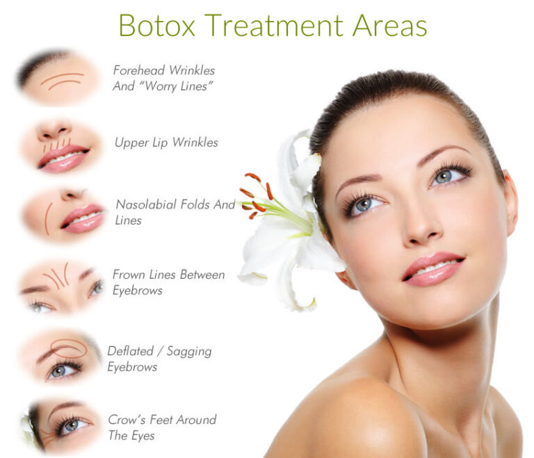 What Areas Can Botox Treat EDM Chicago   Botox Treatment Areas 768x659 